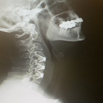 APEX Spine and Neurosurgery - Neurologist Near Me - Bethlehem, Georgia APEX Spine and Neurosurgery - Neurologist Near Me - Bethlehem, Georgia