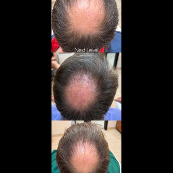 Next Level Med Solutions - Next Level Med Solution's FoLix results post 2 sessions. - Medical Spas Near Me - Plano, Texas