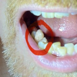 St. Louis Center for Asthetic and Restorative Dentistry - This is the growth that appeared in the extraction site, the one Dr. ITING LEE DDS had no interest in advising me on.