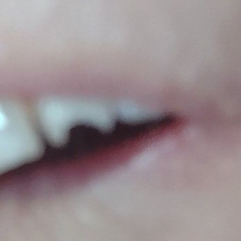 The Tooth Place - After my filling fell out there was a very bit of my tooth left in the front. I - General Dentistry Near Me - Tempe, Arizona