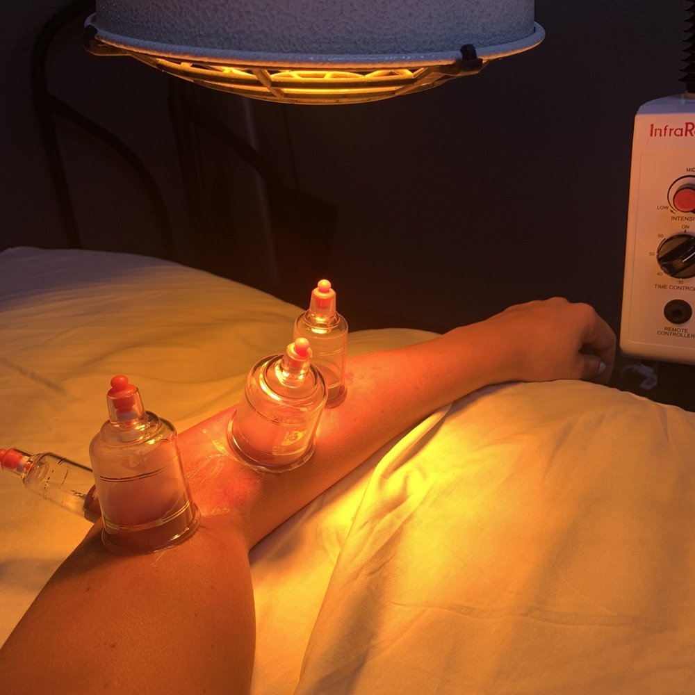 Majed Nagoulat, DC - Cupping for my tennis elbow. - Chiropractors Near Me - Riverside, California Majed Nagoulat, DC - Cupping for my tennis elbow. - Chiropractors Near Me - Riverside, California