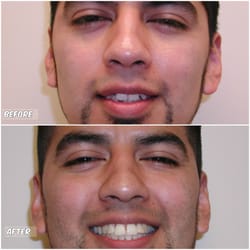 Yorkville Family Dental - Abad came to our office wanting straighter and whiter teeth. He had some teeth removed, full braces and his teeth were also whitened.