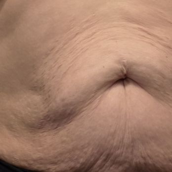 Sono Bello - After Abex - Cosmetic Surgeons Near Me - Raleigh, North Carolina Sono Bello - After Abex - Cosmetic Surgeons Near Me - Raleigh, North Carolina