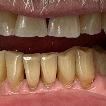Latham Gary M DDS - Before - Oral Surgeons Near Me - Santa Rosa, California Latham Gary M DDS - Before - Oral Surgeons Near Me - Santa Rosa, California