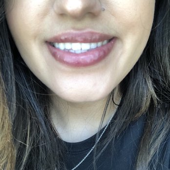 D & E Aesthetics - 3 1/2 weeks after injections. This is what it looked like when I smiled (injections done by Vivian). - Day Spas Near Me - San Jose, California