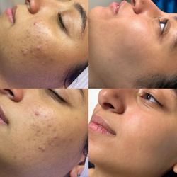 Dalia's Skin Boutique - Before and after, VI Peel, Microdermabrasion, Hydrafacial