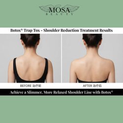 Mosa Beauty Medical Center - Xeomin relax shoulder muscles