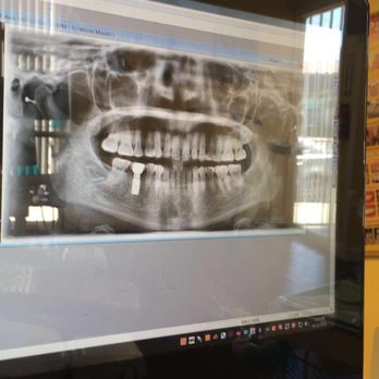 Restore Dental - Hey Doc, I think there's a skull in my implant. - Cosmetic Dentists Near Me - Los Angeles, California Restore Dental - Hey Doc, I think there's a skull in my implant. - Cosmetic Dentists Near Me - Los Angeles, California
