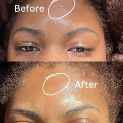 Bright Facial Spa and Thai Massage - Amazing before-and-after of just one Procell Microchanneling treatment!