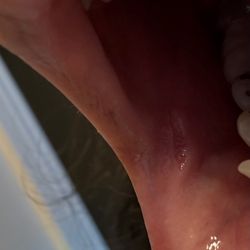 Hollywood Smile Dental - Nadia E Taheri DDS - Cut my Cheek so bad