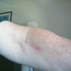 Valley Hand & Orthopaedics - Eli Ziv, MD - Scar diminishing from distal bicep tendon surgery