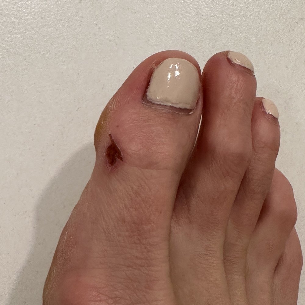 Avalon Nails and Spa - Scrubbed skin off toe by technician trying to remove small callus on the side of big toe - Nail Salons Near Me - St. Augustine, Florida