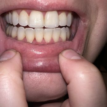Laski M. Kung, DDS - After :) - Orthodontists Near Me - Fair Oaks, California Laski M. Kung, DDS - After :) - Orthodontists Near Me - Fair Oaks, California