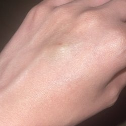 UCR Health - Riverside South - Swollen IV site