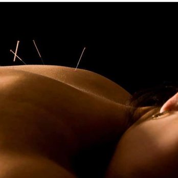 OC Radiant Acupuncture - Acupuncture Near Me OC Radiant Acupuncture - Acupuncture Near Me