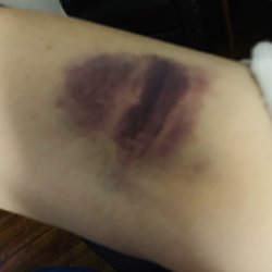 Lifespan Laboratories - Bruise left after blood draw from Lifespan LAN on Smith Street in North Providence.
