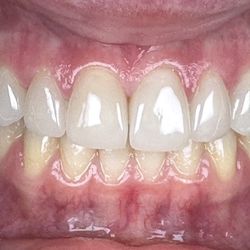 Jeppson Dental - Veneers on front six teeth done by Dr Jeppson.