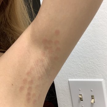 Skin Theory - second day - Laser Hair Removal Near Me - Corona, California Skin Theory - second day - Laser Hair Removal Near Me - Corona, California