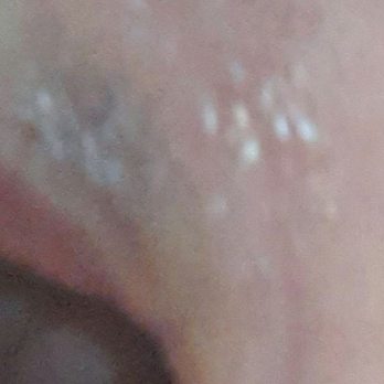 Skin Charm - Nearly a week after botox. Purchased arnica gel to help with the bruising. Fingers crossed the arnica works. - Medical Spas Near Me - Scottsdale, Arizona Skin Charm - Nearly a week after botox. Purchased arnica gel to help with the bruising. Fingers crossed the arnica works. - Medical Spas Near Me - Scottsdale, Arizona