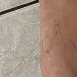 DISC Sports & Spine Center - Marina del Rey - I got a plasma injection on my tibial tendon