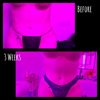 360 Degree Body Sculpting Studio - Body Contouring Near Me - San Fernando, California