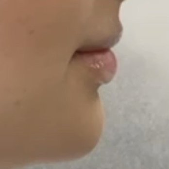 PureSkin Aesthetics - Before (this is with numbing cream on). No projection - Medical Spas Near Me - Tysons, Virginia