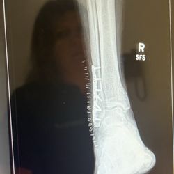 Orthosouth - Bartlett - Ankle plate