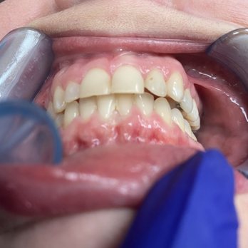 The Modern Orthodontist - This is what Gretchen thinks is a correct bite - Orthodontists Near Me - Vancouver, Washington The Modern Orthodontist - This is what Gretchen thinks is a correct bite - Orthodontists Near Me - Vancouver, Washington