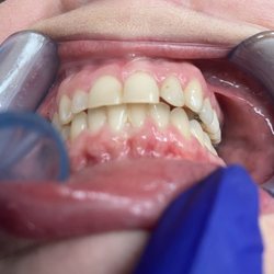 The Modern Orthodontist - This is what Gretchen thinks is a correct bite