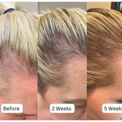 Deja Vu Med Spa & Salon - PRP scalp
