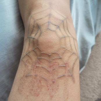 Zapatat - scarring and about halfway done - Tattoo Removal Near Me - Arlington, Virginia
