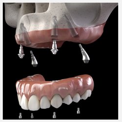 Smile Bright Family Dentistry - Newman - All on 4 Implants