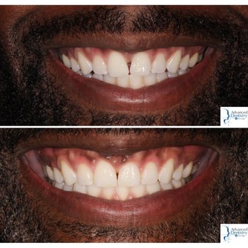 Advanced Dentistry by Design - Invisalign used to improve the angulation of the patient's teeth and reduce the spacing between the front two teeth - General Dentistry Near Me - San Jose, California