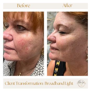 Cisne Wellness - Client transformation with BBL (Broadband Light) - Medical Spas Near Me - Lakeland, Florida Cisne Wellness - Client transformation with BBL (Broadband Light) - Medical Spas Near Me - Lakeland, Florida