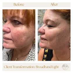 Cisne Wellness - Client transformation with BBL (Broadband Light)