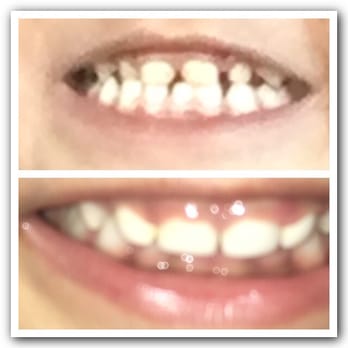 Pinnacle Pediatric Dentistry - Before and after white caps and procedure - Pediatric Dentists Near Me - Houston, Texas Pinnacle Pediatric Dentistry - Before and after white caps and procedure - Pediatric Dentists Near Me - Houston, Texas