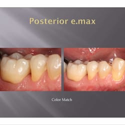 Robert Schellentrager, DMD - We match the shade of your crowns to your natural teeth.
