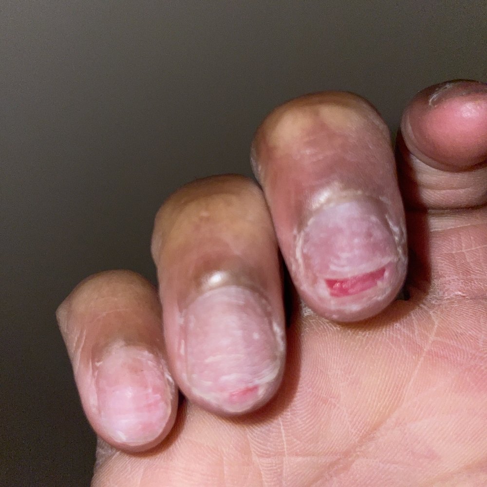 NY Tony's Nails - MY BROKEN NAIL BEDS AFTER SERVICING AT TONYS NAILS!!! - Nail Salons Near Me - The Bronx, New York NY Tony's Nails - MY BROKEN NAIL BEDS AFTER SERVICING AT TONYS NAILS!!! - Nail Salons Near Me - The Bronx, New York