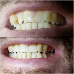 Carlos Leal, DDS - South Gate Dental Clinic - One appointment.
No injection. Happy patient