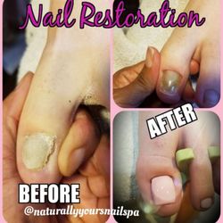 Naturally Yours Nail Spa - Client was wearing flip flops and her foot was stepped on, causing her toe nail to ripp off. 
Nail Restorations start at $25