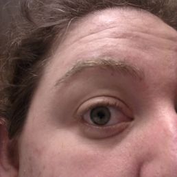 May be hard to see but, brow irritation and a nicked spot - scabbed over. May be hard to see but, brow irritation and a nicked spot - scabbed over.
