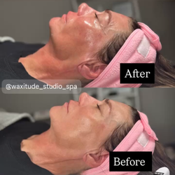 Radiant Aesthetics - Jet Plasma Skin Tightening & HydroFacial Treatment