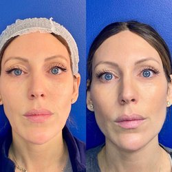 Split Rock Aesthetic Institute - This is incredible!
PdoMAX lower face threads placed last night at 6:30 and her photo was at noon today .