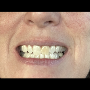 Ryan Duval - Loop 101 Endodontics - Before - Endodontists Near Me - Scottsdale, Arizona Ryan Duval - Loop 101 Endodontics - Before - Endodontists Near Me - Scottsdale, Arizona