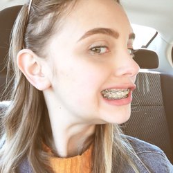 Chadwell Orthodontics - Before getting these train tracks off