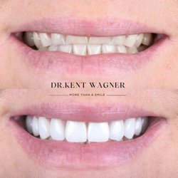 Wagner Dental - Beautiful Veneer Transformation.