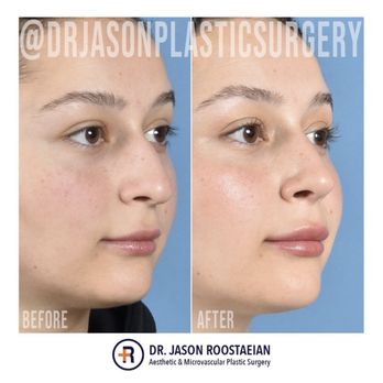 Jason Roostaeian, MD - Tip refined - Cosmetic Surgeons Near Me - Los Angeles, California Jason Roostaeian, MD - Tip refined - Cosmetic Surgeons Near Me - Los Angeles, California