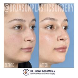 Jason Roostaeian, MD - Tip refined