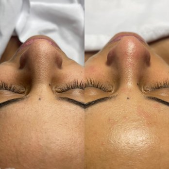 Nana Alviarez Beauty Studio - Before & After. Service: Microdermabrasion Facial - Skin Care Near Me - Katy, Texas Nana Alviarez Beauty Studio - Before & After. Service: Microdermabrasion Facial - Skin Care Near Me - Katy, Texas