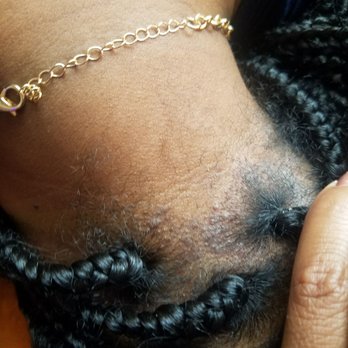 Claudette's Braiding Gallery - More bumps and scabs from the too tight braiding. Don't go here! This is not psoriasis. - Hair Salons Near Me - Takoma Park, Maryland